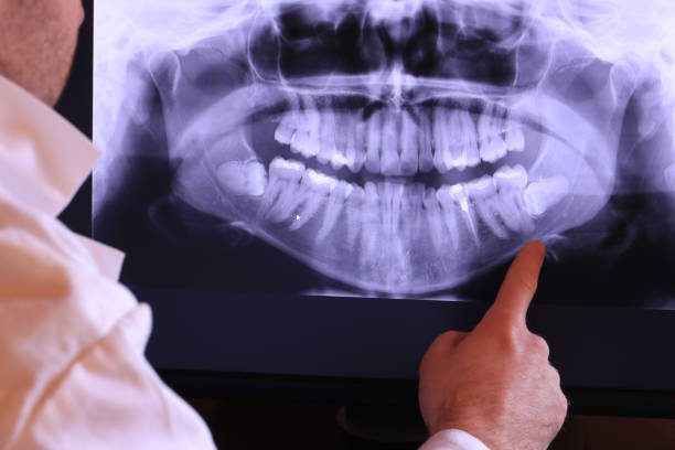 Best Knocked-Out Tooth (Avulsed Tooth) Treatment in Dixon, KY